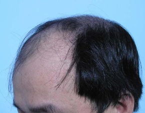 病理性脱发的症状类型有哪些